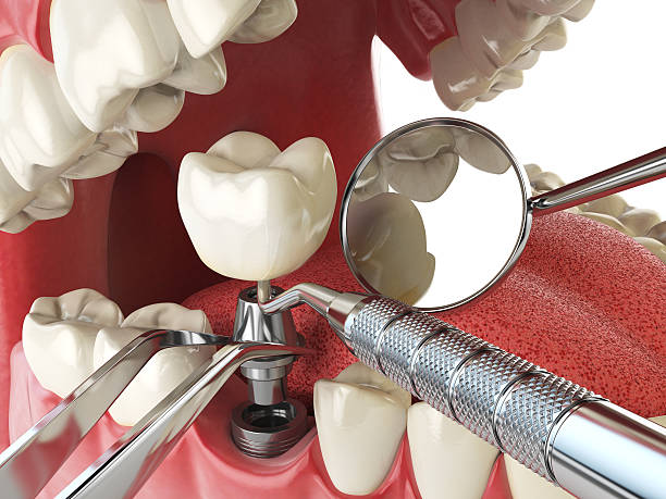 Best Emergency Tooth Extraction in Goodland, KS